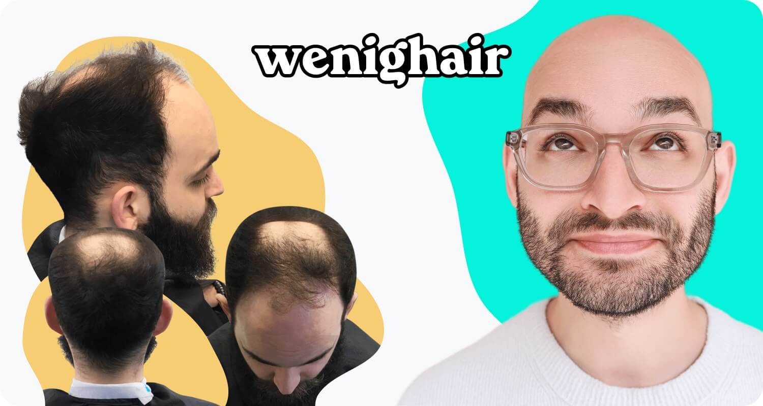 Vorher Nachher Foto von Mann mit Haarausfall transformation zur Glatze.